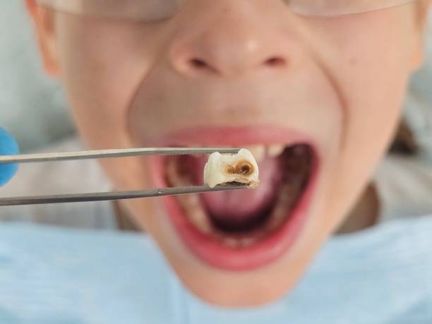Best Emergency Wisdom Teeth Removal in American Fork, UT